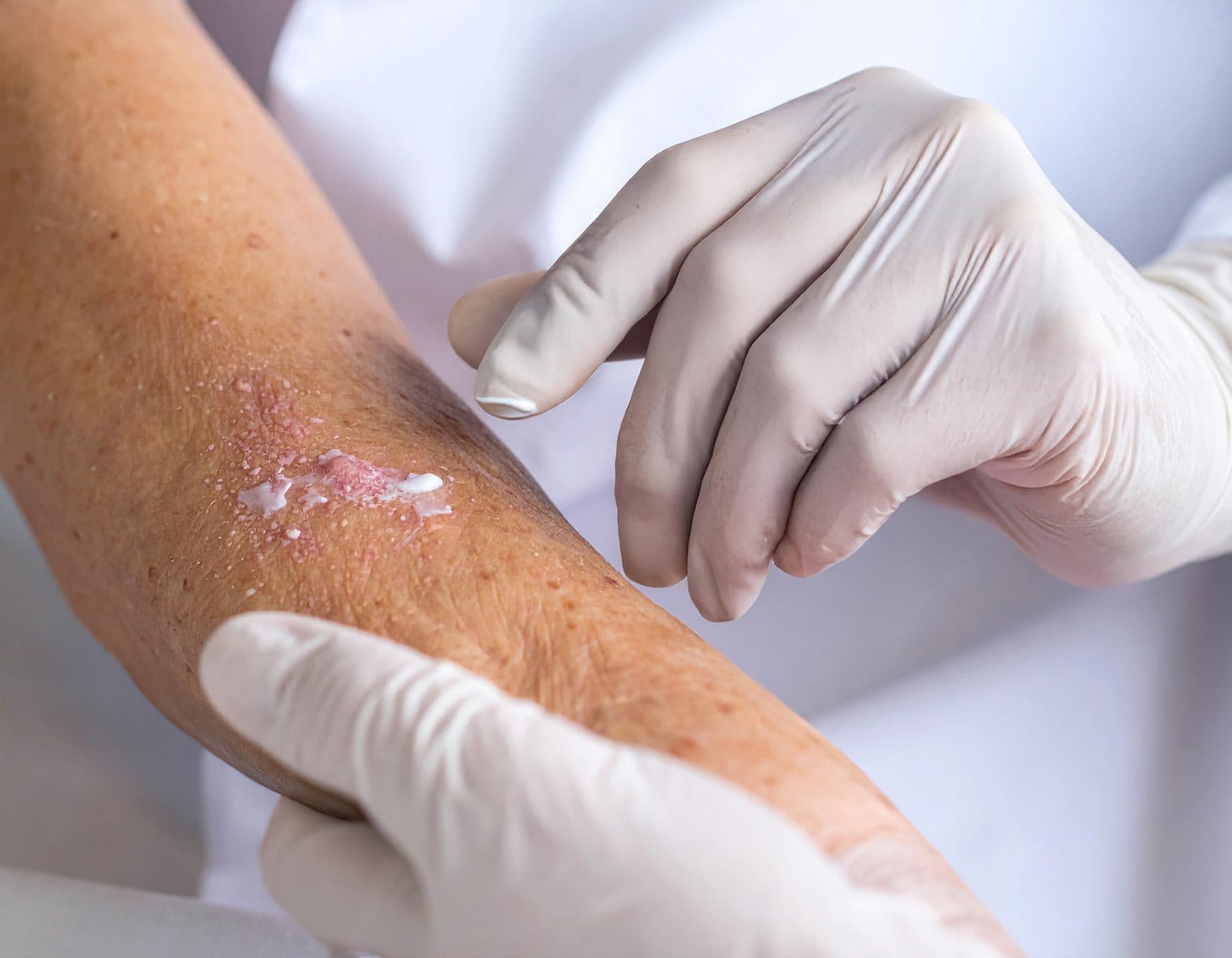 Arm einer älteren Person mit Gürtelrose, Hände mit Handschuhen behandeln die betroffene Stelle